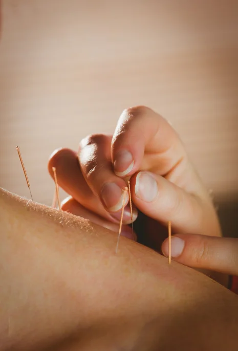 Hands-Acupuncture