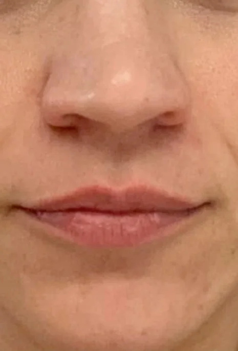 After-Micro-Needling
